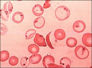 poza despre anemii hemolitice